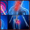 Fibromyalgia